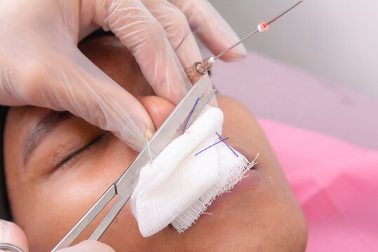 Cutting excess PDO thread with scissors. Plastic surgeon performing a Hiko nose thread lift on a young asian man