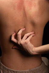 Young man, shirtless, scratching his back with his hands. Skin disease. Irritation, allergy.