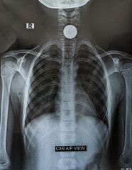 x ray image of chest showing circular coin in oesophagus