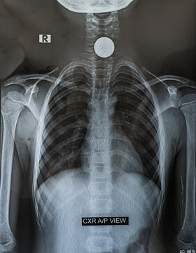 x ray image of chest showing circular coin in oesophagus