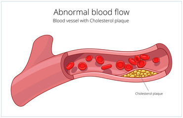 Blood vessel and cholesterol plaque medical science educational PNG illustration