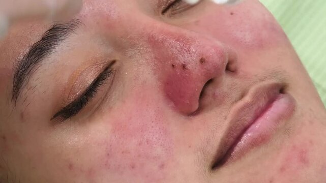 A female patient receives hydrafacial treatment at a beauty clinic. Actual procedure being done, with some mild redness in the skin.