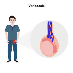 Varicocele male disease 