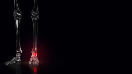 The Bone crystal for sprained ankle concept 3d rendering.