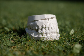 White plaster impression of the dental jaw of a patient with crooked teeth and malocclusion....