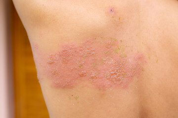 close up of a young woman with a bandage