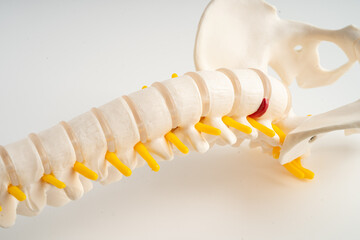 Lumbar spine displaced herniated disc fragment, spinal nerve and bone. Model for treatment medical in the orthopedic department.