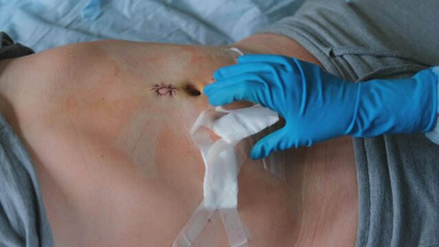 Hands of medic or nurse in blue gloves examining a fresh suture on a male stomach after laparoscopy surgical removal of appendicitis. Doctor examines of the patient. Man belly with medical stitches