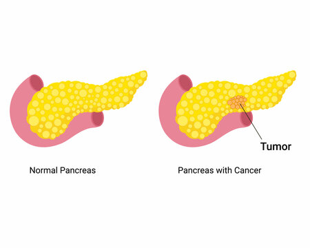 normal and pancreas with cancer human internal organ anatomy tumor demonstrated on pancreas