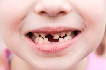 Kid shows off first missing tooth. Children without one tooth smiles