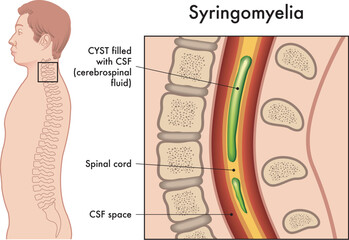 Medical illustration shows the symptoms of Syringomyelia, a pathology that affects the spine.