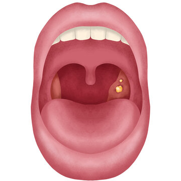 Tonsil stone