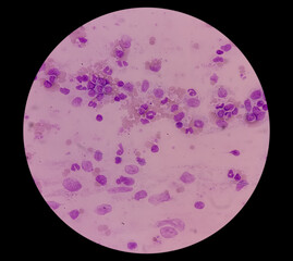 Microscopic image showing Chronic myeloid leukaemia (CML) is a type of cancer, all stage of...
