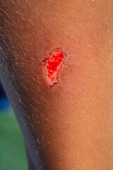 Open wound bleeding on the skin