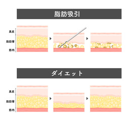 脂肪吸引_ダイエットの違い