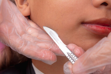 Close-up of dermaplaning or microplaning procedure to closely shave and exfoliating the skin.