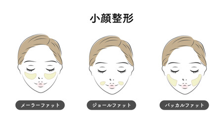 小顔整形