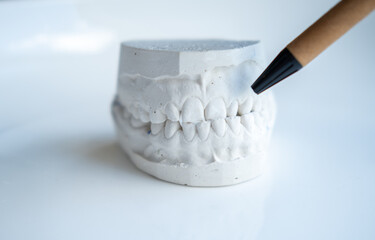 White plaster impression of the dental jaw of a patient with crooked teeth and malocclusion....