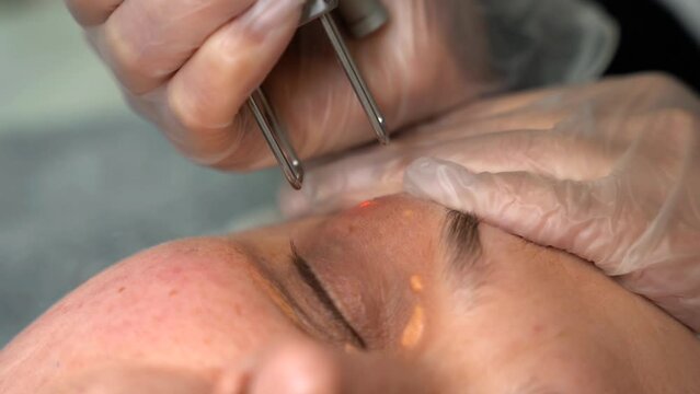 Dermatologist doctor removes Xanthelasma on Female Patient face with modern technology CO2 laser equipment. 4k close-up shot.