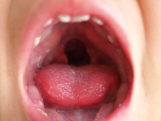 Child girl showing an uvula in a cleft palate. Closeup photo, blurred.
