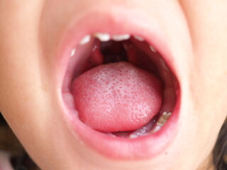 Child girl showing an uvula in a cleft palate. Closeup photo, blurred.