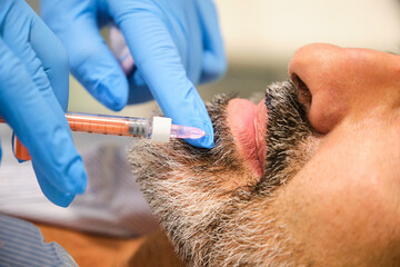 Close up of a man getting Botox lip flip by a aesthetic doctor in a clinic.
