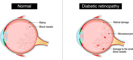 Diabetic retinopathy