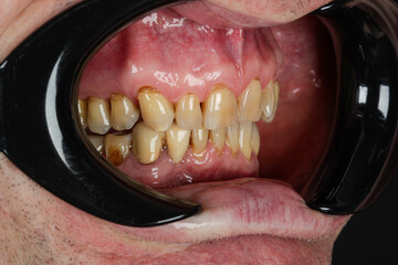 Wedge-shaped (cone-shaped) section of enamel loss in the area of the tooth neck. Destruction of the...