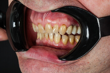 Obraz premium Wedge-shaped (cone-shaped) section of enamel loss in the area of the tooth neck. Destruction of the hard part of the tooth