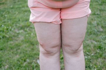 Cellulite leg woman. Test fat hips treatment. Over weight liposuction. Remove striae
