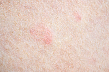 Skin allergy rash dermatitis texture close up