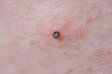 A tick on the skin that transmits dangerous diseases such as tick-borne encephalitis or Lyme disease.