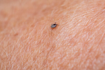 A tick on the skin that transmits dangerous diseases such as tick-borne encephalitis or Lyme...
