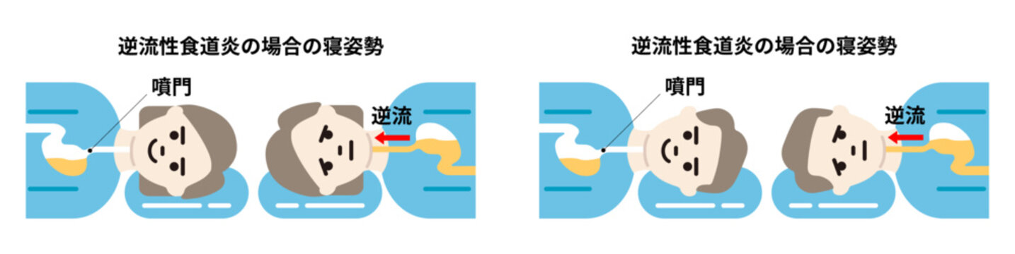 胃酸の逆流/逆流性食道炎の場合の寝姿勢　男女