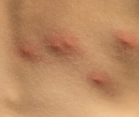 Fototapeta premium mosquito bites on a child's back as a background.