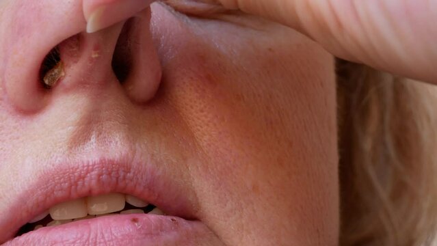 Herpes on the nose - middle-aged caucasian woman with herpes her on nose, Human Virus.  close-up.