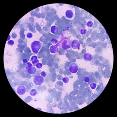 BMS (bone marrow study) : Reactive marrow. Megakaryocytes and plasma cells increased.