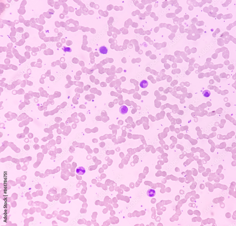 Sticker BMS (bone marrow study) : Reactive marrow. Megakaryocytes and plasma cells increased.