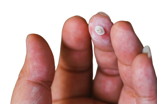 Fingers with warts, warts on hands, germs and accumulation, treatment. Isolated Background.
