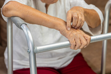 Elderly woman itchy and scratching arm because dry skin.