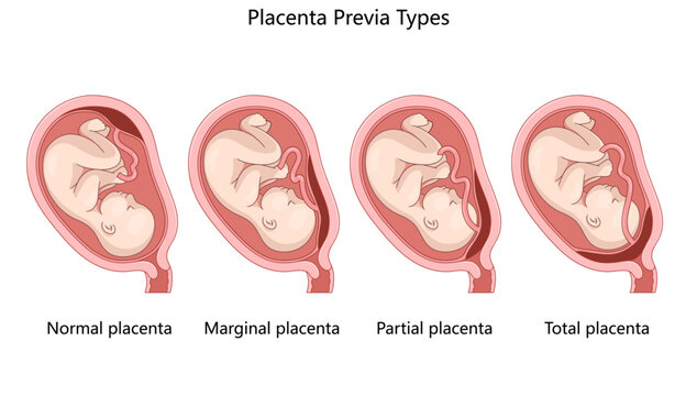 different types of placenta previa, showing normal, marginal, partial, and total placenta placement diagram hand drawn schematic vector illustration. Medical science educational illustration