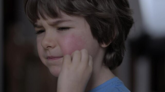 Child Scratching Red Rash on Face. Boy Scratches Atopic Skin. Dermatitis, Diathesis, Hives Allergy on Child Body and Face. Irritation and Pruritus. Boy Having Allergic Reaction on Skin to Food.