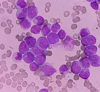 Acute myeloid leukemia (AML). Smear show monocytes and mostly blast cell. Anemia and thrombocytopenia. Most common acute leukemia affecting adults.