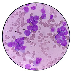 Acute myeloid leukemia (AML). Smear show monocytes and mostly blast cell. Anemia and...