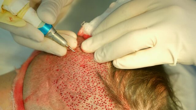 Surgeon cuts out hair grafts from patient head nape using punch to hair transplant. Problem of baldness of men in middle age, treatment of alopecia by hair transplantation surgery in clinic hospital.