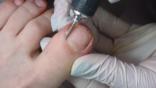 Professional hardware pedicurist, podiatrist cleaning nails using a nail miller