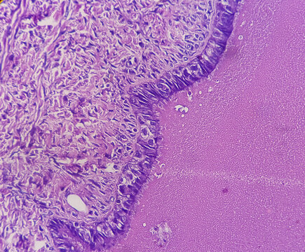 Microscopic image of Papillary borderline serous tumor of the ovary (low malignant potential) with branching papillae lined by stratified cells with nuclear atypia. Ovarian serous borderline tumors