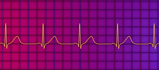 Long QT syndrome ECG, 1st type, 3D illustration