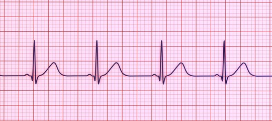 Long QT syndrome ECG, 1st type, 3D illustration