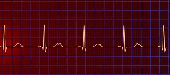 Long QT syndrome, type 2. 3D illustration of an electrocardiogram (ECG) showing prolonged QT interval with notched and of lower amplitude T-waves.